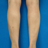BX leg 2M after.jpgのサムネール画像のサムネール画像